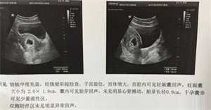 广州代孕流程是什么_广州代孕的费用是多少【广州科学代孕，迎接二胎来临】