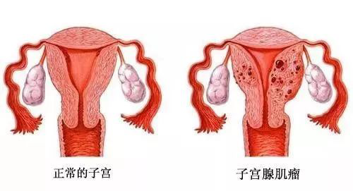 找广州代妈要多少钱_做好这4点，子宫腺肌症病人也能成功怀孕